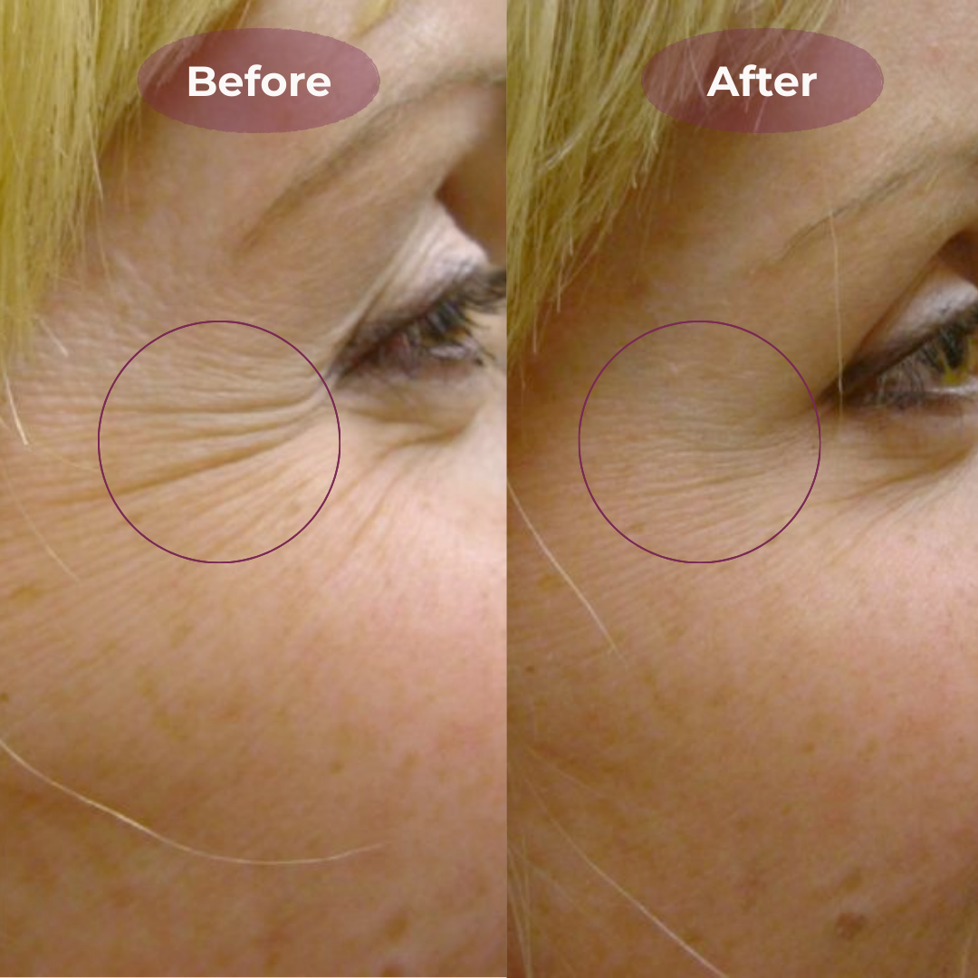 Fade Wrinkles & Fine Lines Naturally