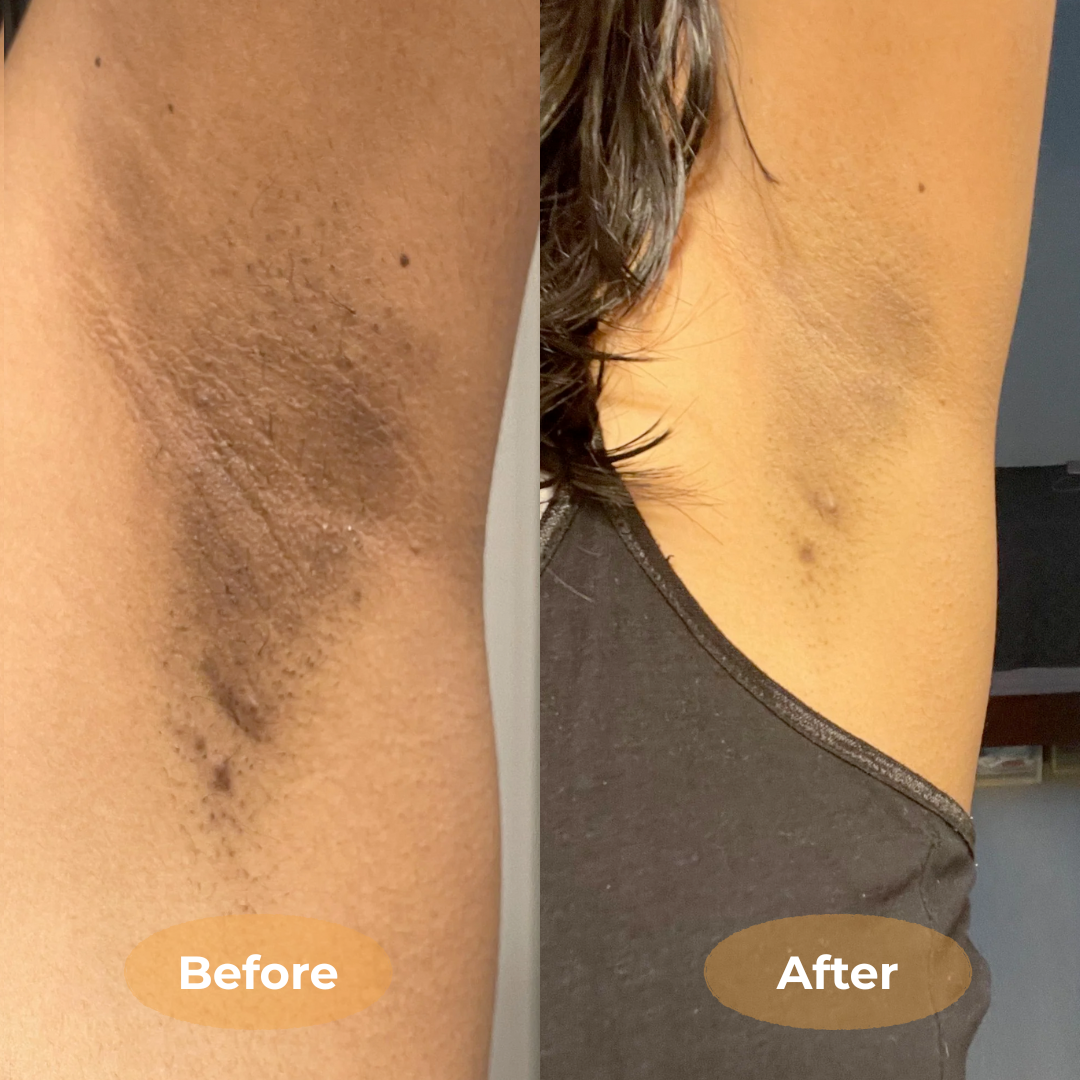 Brighten Stubborn Dark Areas Naturally